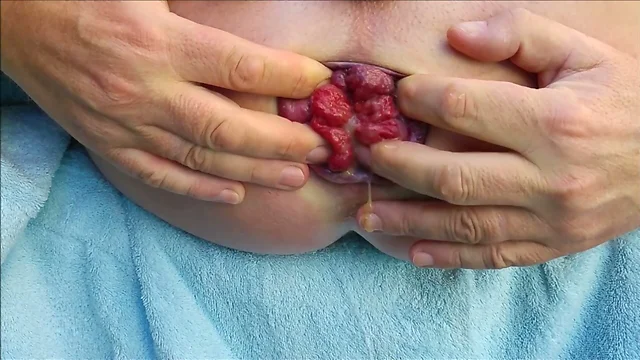 Self anal fisting my dirty prolapse