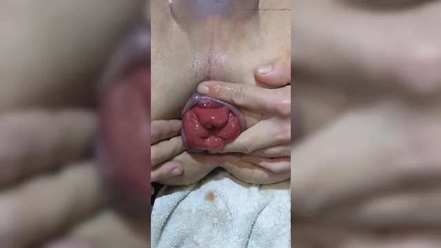 Pumping anal prolapse