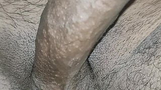 Penis peonies and phimosis: a closer look